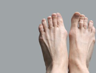 hallux valgus surgery