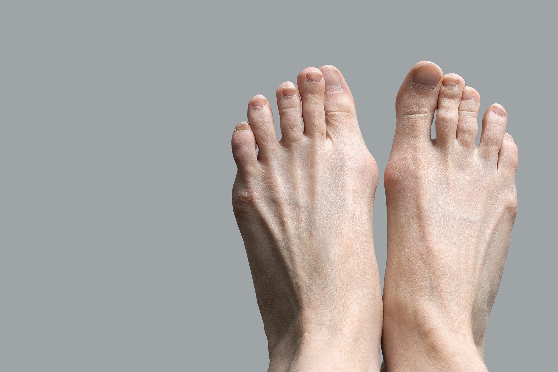 hallux valgus surgery